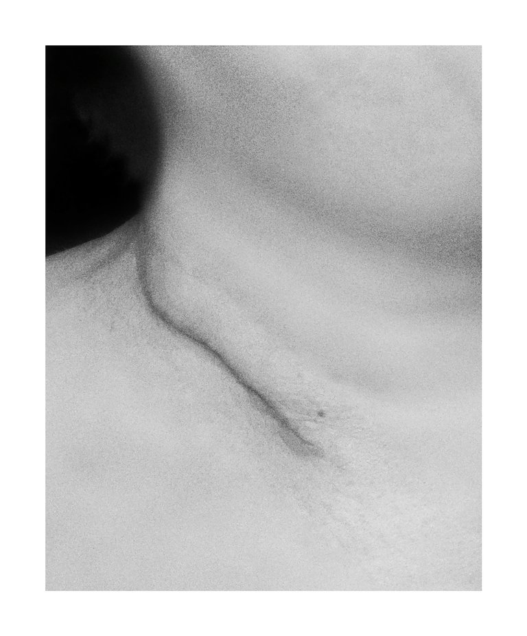 Ett foto av en hals med ett ärr.